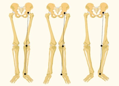 זוויות שונות של מפרקי הברך