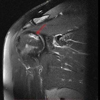MRI של נמק בכתף