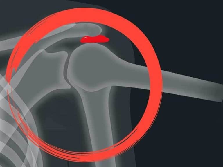 איך למנוע את תסמונת הצביטה בכתף
