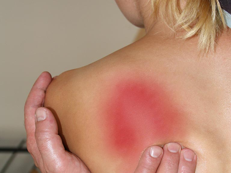 פציעות שכיחות בגב העליון ומניעתן