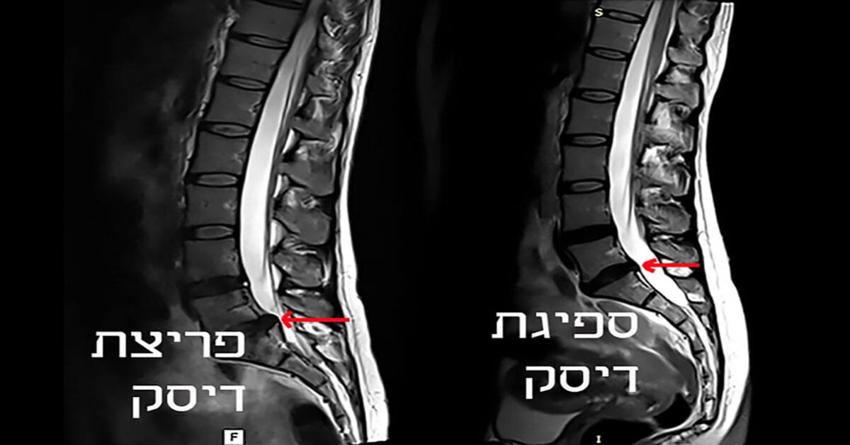 ספיגת דיסק האם זה אפשרי
