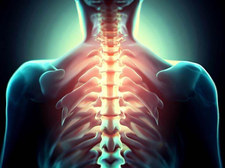 היצרות תעלת השדרה האם כירופרקט יעזור
