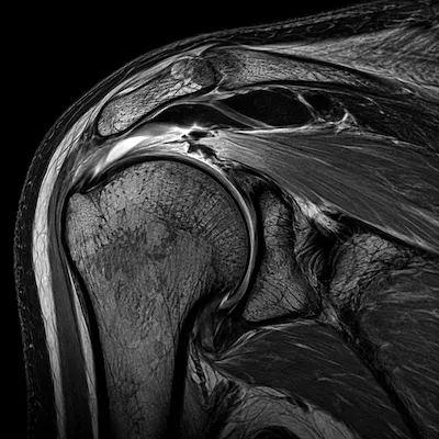 MRI לכתף: מתי הבדיקה נחוצה ומה היא מגלה? 2 MRI לכתף: מתי הבדיקה נחוצה ומה היא מגלה?