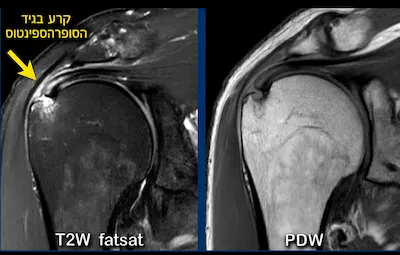 MRI לכתף: מתי הבדיקה נחוצה ומה היא מגלה? 1 MRI קרע בגיד הסופרהספינטוס