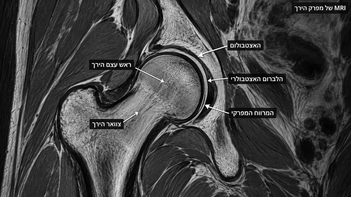 עמוד ראשי 41 MRI של מפרק ירך תקין