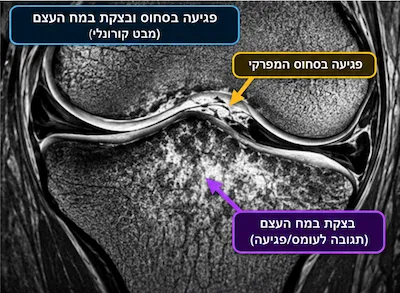 MRI לברך: מתי הבדיקה נחוצה ומה היא מגלה? 2 בצקת מח עצם
