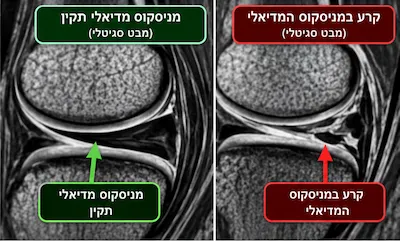 MRI לברך: מתי הבדיקה נחוצה ומה היא מגלה? 1 קרע במניסקוס