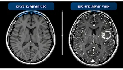 MRI עם חומר ניגוד: מתי צריך אותו והאם הוא בטוח? 1 MRI מוח לפני ואחרי הזרקת חומר ניגודי