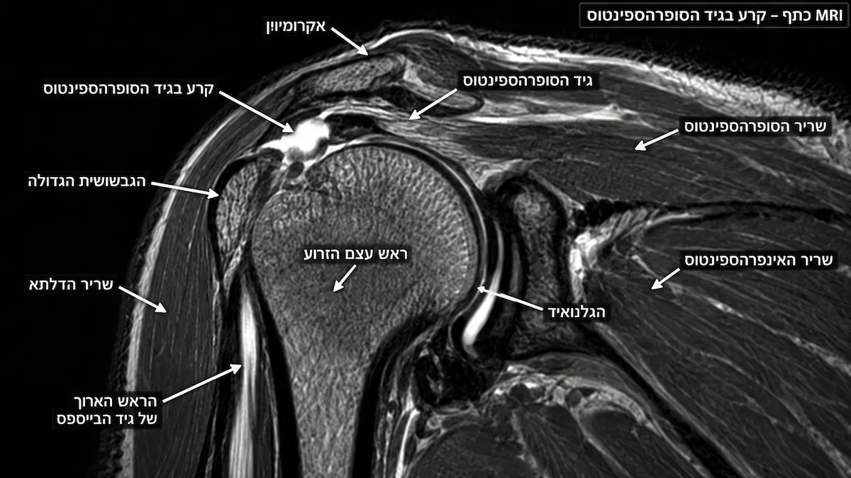 עמוד ראשי 41 MRI לכתף: מתי הבדיקה נחוצה ומה היא מגלה?