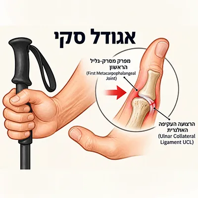 אגודל סקי: אבחון וטיפול 1 אגודל סקי: אבחון וטיפול
