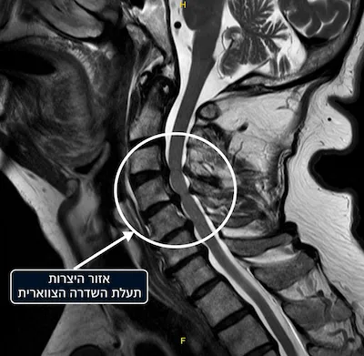 היצרות בתעלת השדרה הצווארית