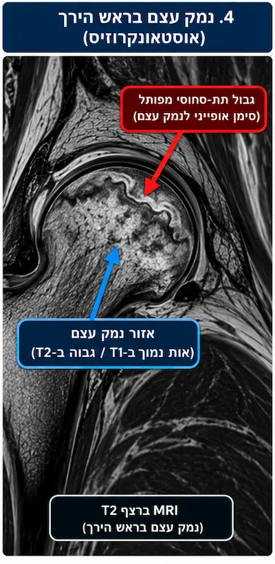 נמק עצם בראש הירך