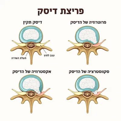 פריצת דיסק בארבעה שלבים