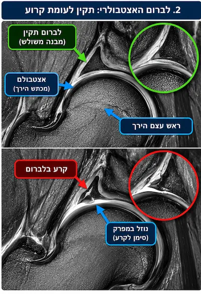קרע בלברום מול לברום בריא