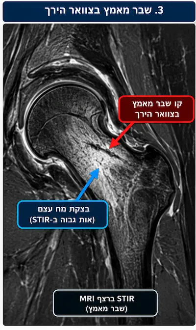שבר מאמץ במפרק הירך